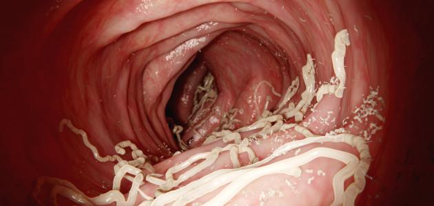 بحث عن دودة الأسكارس بحث عن دودة الأسكارس