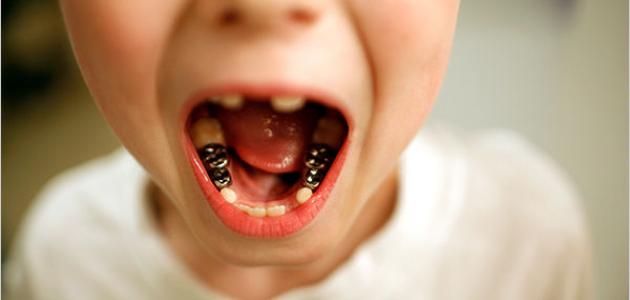 تآكل الأسنان - فيديو تآكل الأسنان - فيديو