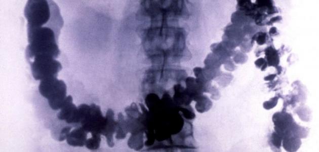 تضخم القولون تضخم القولون