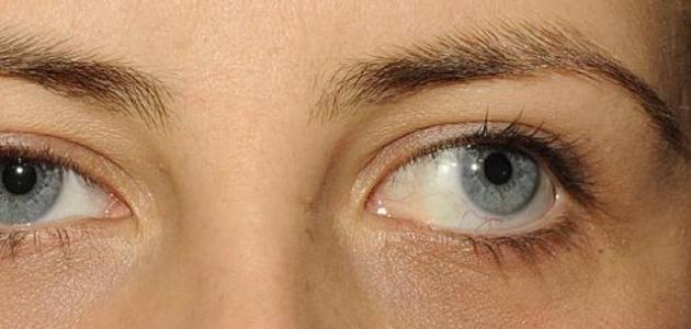 تعريف انحراف العين تعريف انحراف العين