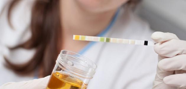 تغير لون البول تغير لون البول