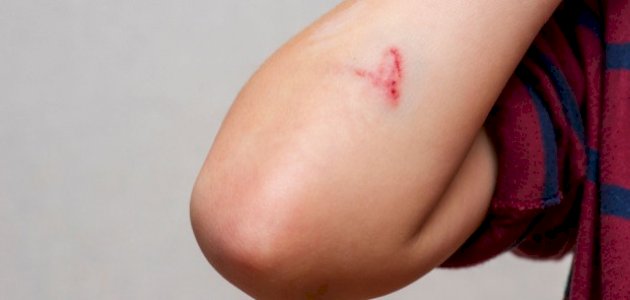 تفسير حلم الجرح في المنام تفسير حلم الجرح في المنام