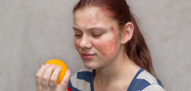 حساسية الجلد من الأكل حساسية الجلد من الأكل