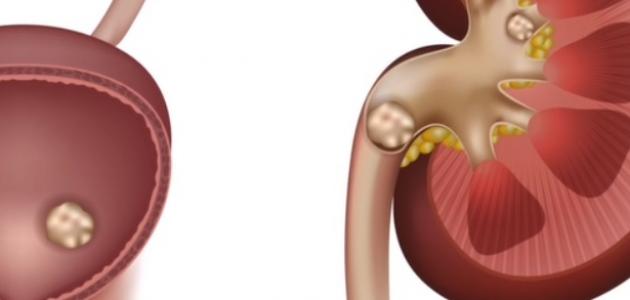 حصوة الحالب - فيديو