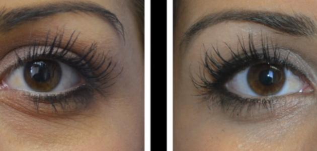 حقن الفيلر تحت العين - فيديو