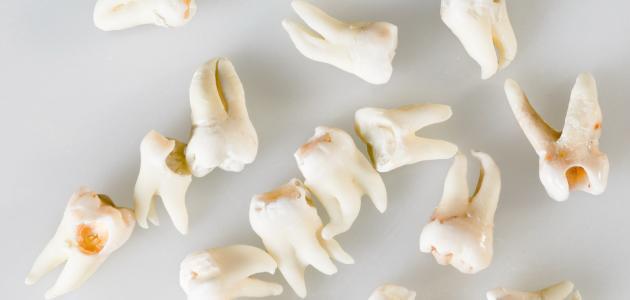 خلع ضرس العقل المائل خلع ضرس العقل المائل