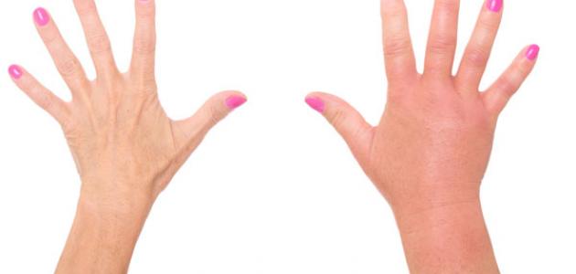 زيادة السوائل في الجسم زيادة السوائل في الجسم