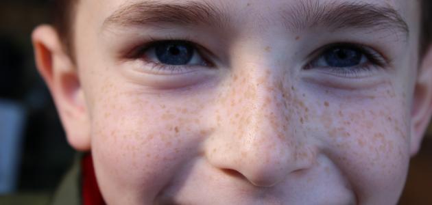 زيادة صبغة الميلانين في الجسم