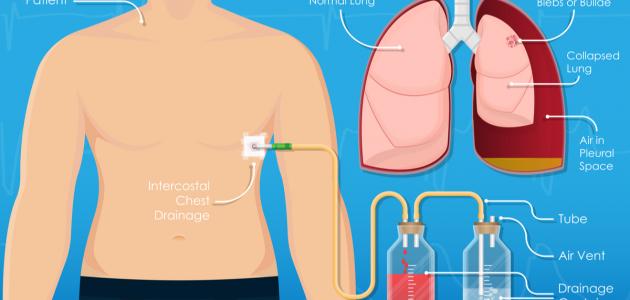 سحب الماء من الرئة سحب الماء من الرئة