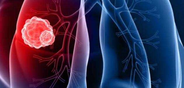 سرطان الرئة ،أعراضه و أسبابه