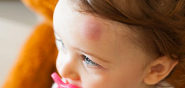 سقوط الطفل على رأسه سقوط الطفل على رأسه