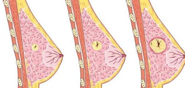 شكل الورم السرطاني في الثدي
