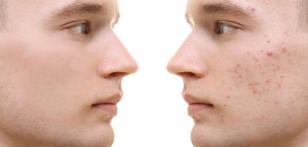 طرق إزالة الحبوب الدهنية من الوجه