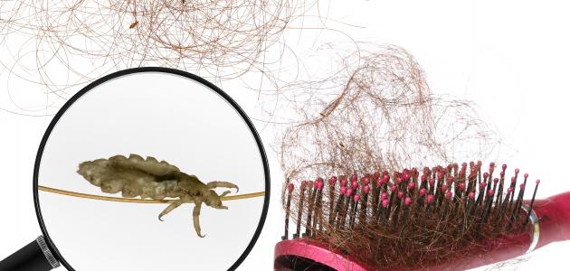 طرق التخلص من القمل والصيبان نهائياً طرق التخلص من القمل والصيبان نهائياً