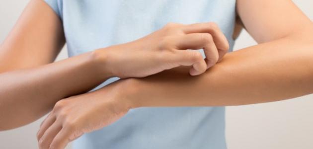 طرق الوقاية من الجرب