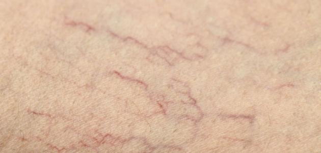 طرق الوقاية من مرض دوالي الساقين طرق الوقاية من مرض دوالي الساقين