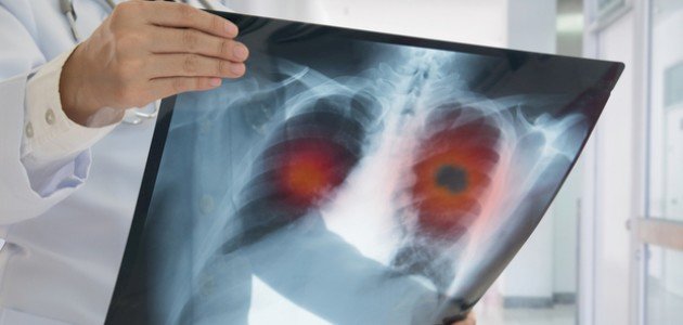 طرق علاج السرطان طرق علاج السرطان