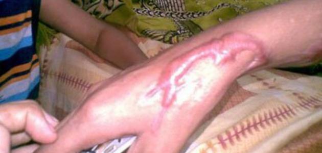 طرق لإزالة آثار الجروح والحروق القديمة