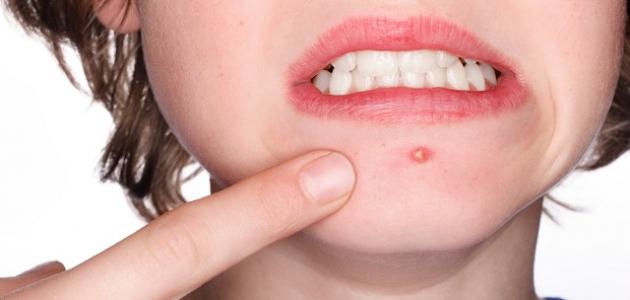 طرق لإزالة آثار الحبوب من الوجه بسرعة