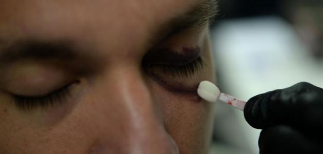 طريقة إزالة آثار الكدمات من الوجه