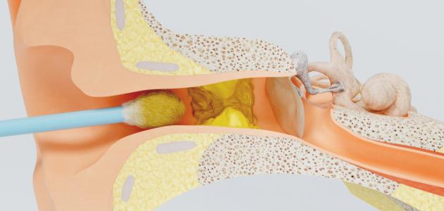 طريقة إزالة شمع الأذن طريقة إزالة شمع الأذن