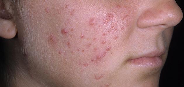 طريقة سهلة لإزالة حب الشباب نهائياً طريقة سهلة لإزالة حب الشباب نهائياً