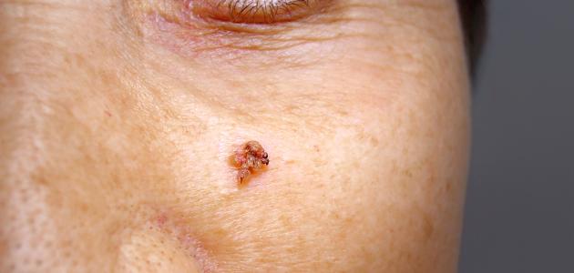 طريقة علاج الثالول طريقة علاج الثالول