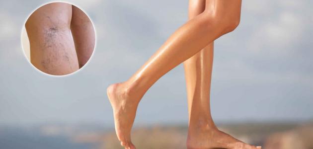 ظاهرة الرينود ظاهرة الرينود