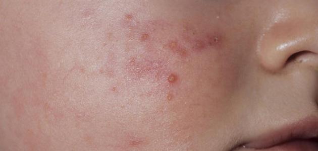 ظهور الحبوب على وجه الرضيع ظهور الحبوب على وجه الرضيع