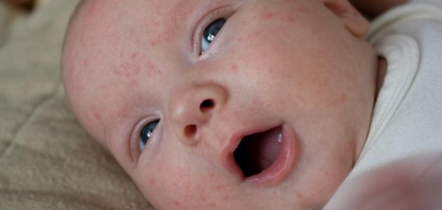 ظهور الحبوب عند الرضع