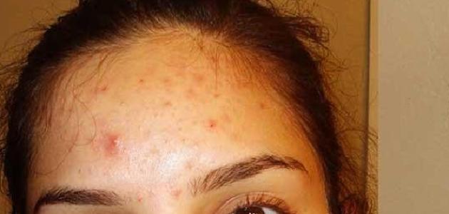 ظهور الحبوب في الجبهة