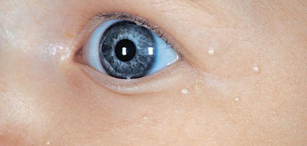 ظهور بقع بيضاء في الوجه عند الأطفال