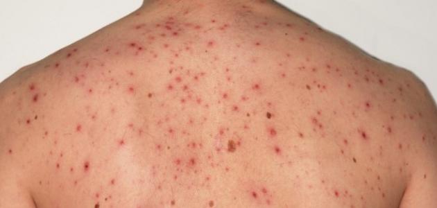 ظهور حب الشباب في الظهر