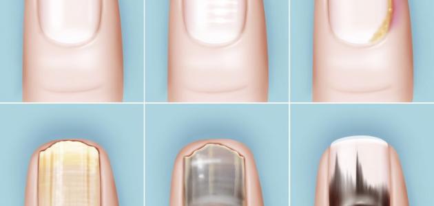 ظهور خطوط سوداء على الأظافر ظهور خطوط سوداء على الأظافر