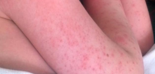 ظهور طفح جلدي على الجسم ظهور طفح جلدي على الجسم