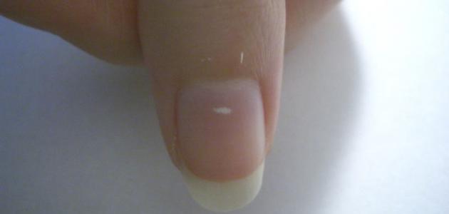 ظهور نقط بيضاء على الأظافر