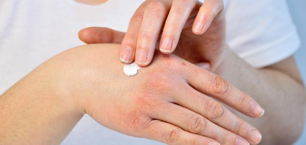 علاج الحساسية والحكة