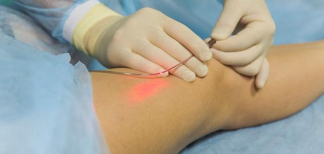 علاج الدوالي بالليزر علاج الدوالي بالليزر