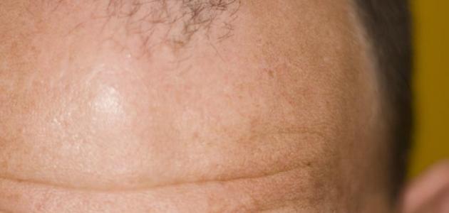 علاج الصلع بالثوم علاج الصلع بالثوم