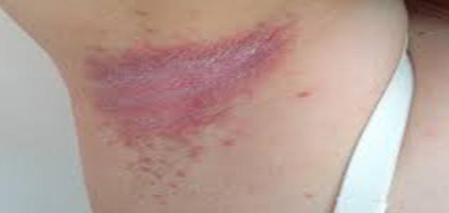 علاج الفطريات تحت الإبط