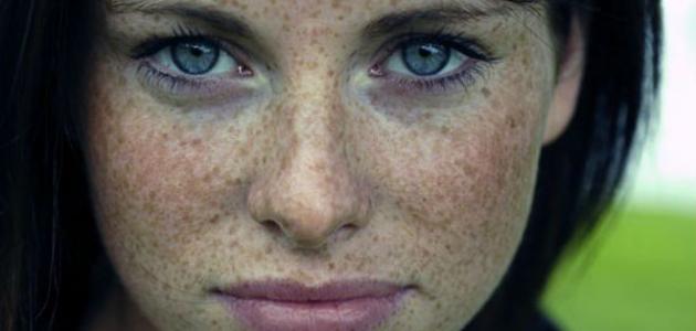 علاج النمش - فيديو