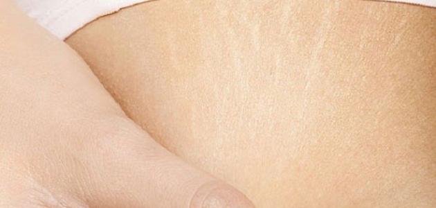 علاج تشققات الجسم علاج تشققات الجسم