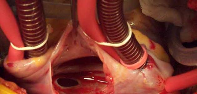 علاج ثقب القلب بين البطينين