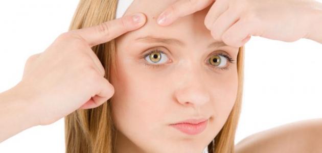 علاج حب الشباب الموضعي - فيديو