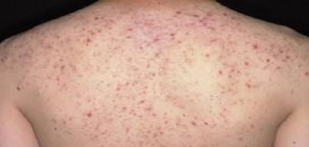 علاج حب الشباب في الظهر والصدر