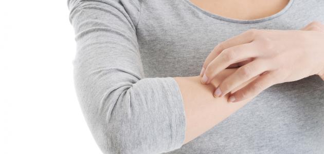 علاج حساسية الجلد علاج حساسية الجلد