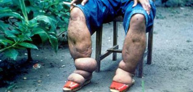 علاج داء الفيل