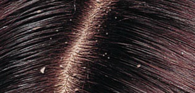 علاج قشرة الشعر الجاف