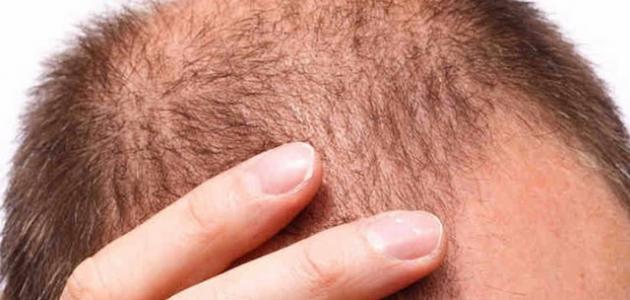 علامات الصلع عند الرجال