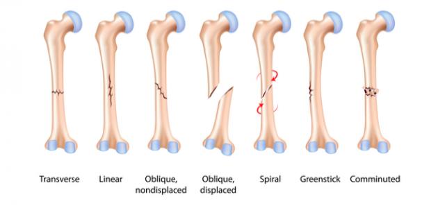 علامات جبر العظام